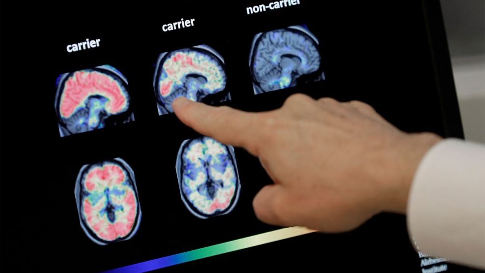 Descubrieron 5 casos de Alzheimer que se desarrollaron por un tratamiento médico