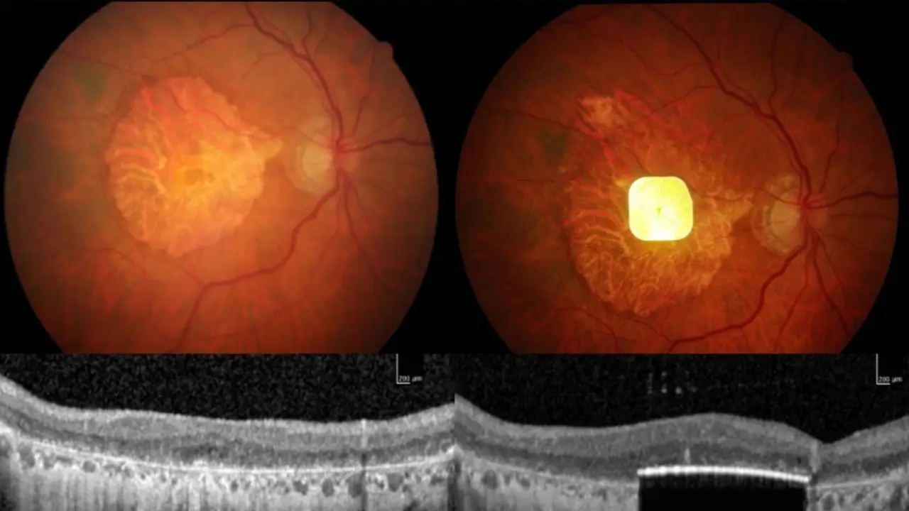 Una prótesis ocular permite leer a personas con ceguera irreversible