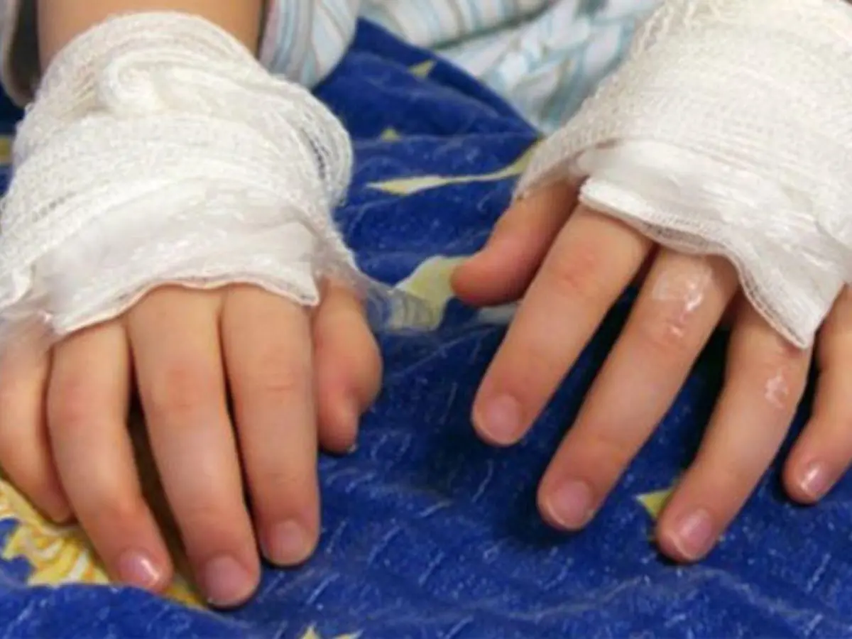 Seis menores sufren graves quemaduras por pólvora durante noche de Navidad en Honduras