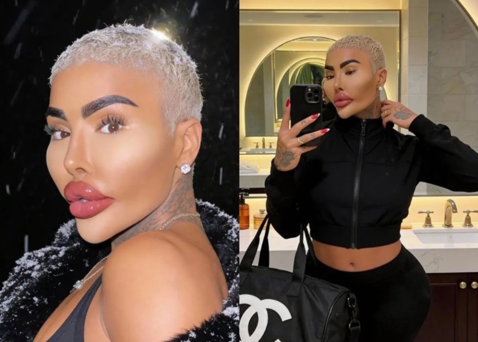 Fallece el “Rey de los Labios”, influencer británico tras presuntas complicaciones de cirugía estética